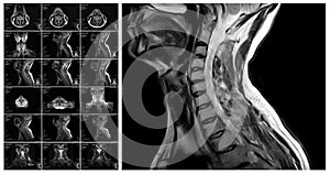 Magnetic resonance imaging of the cervical spine. photo