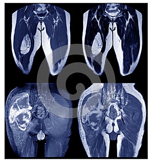Magnetic Resonance Imaging collection images with a lump in the hip area photo