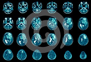 Magnetic resonance imaging Finding  5 cm isodense mass with ill-defined margin and surrounding edema at Left frontal lobe.