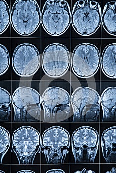 Magnetic resonance imaging of the head and brain, MRI