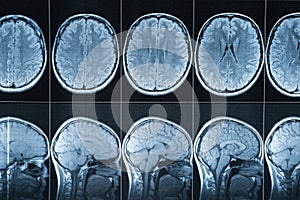 Magnetic resonance imaging of the head, MRI