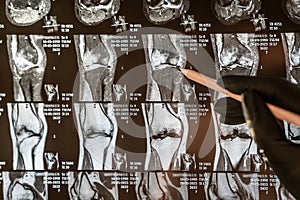 Magnetic resonance imaging of human knee joint for medical diagnosis