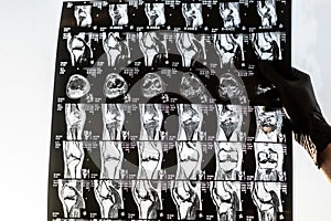 Magnetic resonance imaging of human knee joint for medical diagnosis