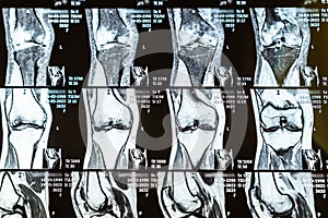 Magnetic resonance imaging of human knee joint for medical diagnosis
