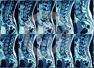 Magnetic resonance imaging of human spine