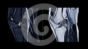 Magnetic resonance imaging of knee joint or MRI knee