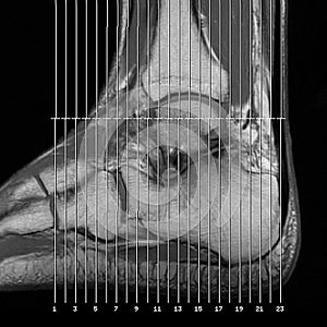 Magnetic resonance imaging - marked measurement lines on the image of the left ankle joint after injury and surgery