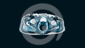 Magnetic Resonance Imaging MRI of both hip sagittal plane. Finding A large mixed heterogeneous fluid collection.