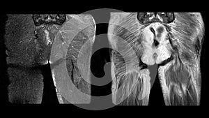 Magnetic Resonance Imaging MRI of both hip sagittal plane. Finding A large mixed heterogeneous fluid collection, located at