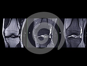 Magnetic resonance imaging or MRI knee comparison Coronal view