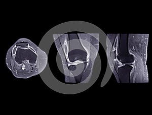 Magnetic resonance imaging or MRI of  knee joint Axial ,Coronal and sagittal T2 FS for detect tear or sprain of the anterior