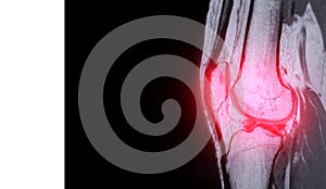 Magnetic resonance imaging or MRI of knee joint sagittal PDW .