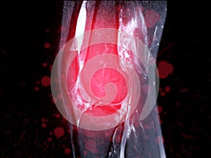 Magnetic resonance imaging or MRI of knee joint Sagittal T2 FS .