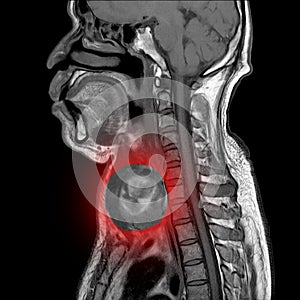 Magnetic resonance imaging MRI of neck, sagittal view, a case of neck.