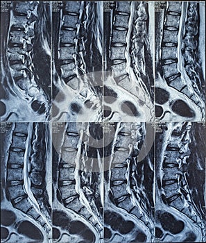 Magnetic resonance imaging or mri scan report of spinal cord or lumbar bulging, x-ray, Lumbar Spine Low Back, lower disc bone