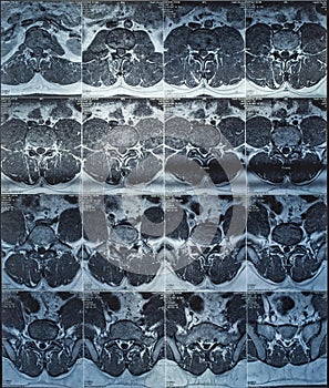 Magnetic resonance imaging or mri scan report of spinal cord or lumbar bulging, x-ray, Lumbar Spine Low Back, lower disc bone