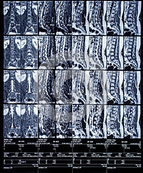 Magnetic resonance imaging or mri scan report of spinal cord or lumbar bulging, x-ray, Lumbar Spine Low Back, lower disc bone