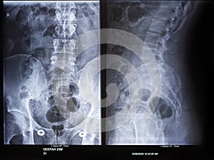 Magnetic resonance imaging or mri scan report of spinal cord or lumbar bulging, x-ray, Lumbar Spine Low Back, lower disc bone