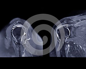 Magnetic Resonance Imaging or MRI of Shoulder Joint Sagittal and Coronal T2 FS  for diagnostic shoulder pain