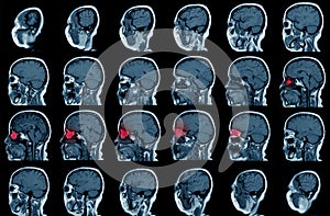 Magnetic resonance imaging MRI of the tumor, sagittal view.A 56 years old man.Healthcare and medical concept