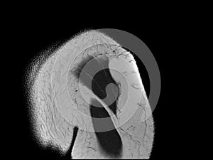 Magnetic resonance imaging of shoulder showing rotator cuff tendon tear. The patient has chronic shoulder pain and weakness. medic