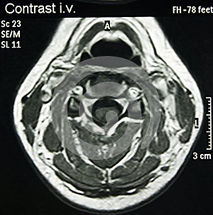 Magnetic Resonance of Neck, MR photo