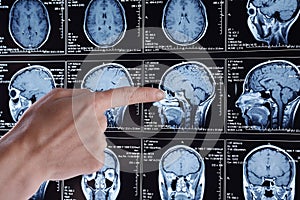 Magnetic resonance scan of the brain. MRI head scan