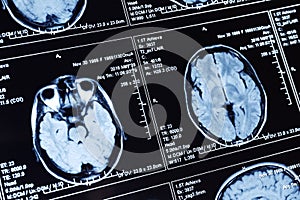 Magnetic resonance scan of the brain. MRI head scan