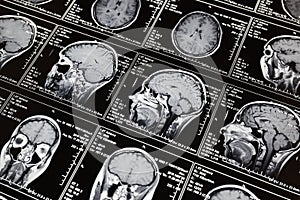 Magnetic resonance scan of the brain. MRI head scan