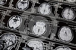 Magnetic resonance scan of the brain. MRI head scan