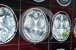 Magnetic resonance scan of the brain with skull. MRI head scan on dark background