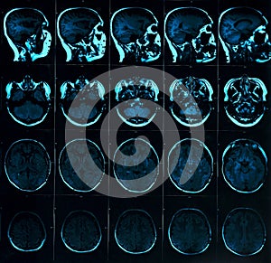 Magnetic resonance scan of the brain with skull. MRI head scan on dark background blue color