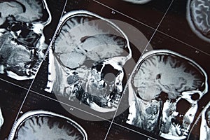 Magnetic resonance scan of the brain with skull. MRI head scan on dark background gray color