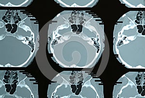 Magnetic resonance Skull base mri