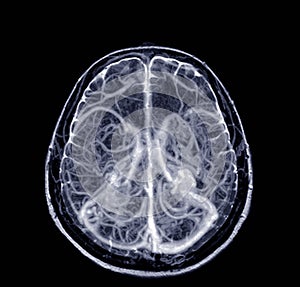 Magnetic resonance venographyMRV Brain of veins in human head.Medical image