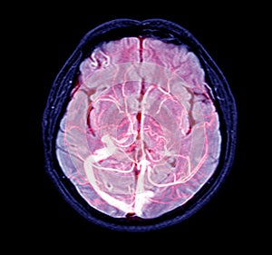 Magnetic resonance venographyMRV Brain of veins in human head.Medical image too soft and blurry when views full solution