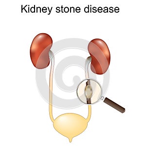 Magnifying glass and Close-up of a stone into Ureter