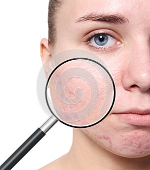 Magnifying young woman`s skin with acne problem