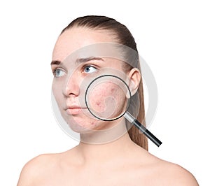 Magnifying young woman`s skin with acne problem