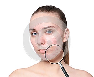 Magnifying young woman`s skin with acne problem