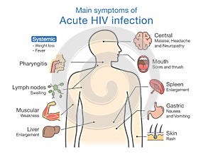 Main symptom of Acute HIV infection.