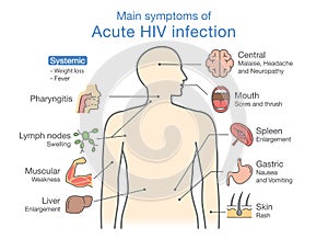 Main symptom of Acute HIV infection. photo