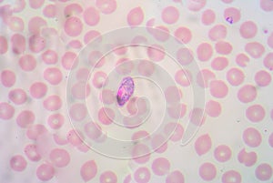 Malaria blood smear pictures