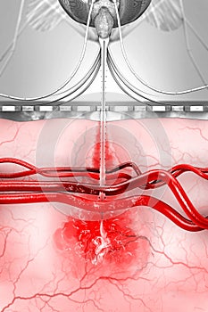 A malaria-infected mosquito transmits malaria pathogens to the human bloodstream during mosquito bites