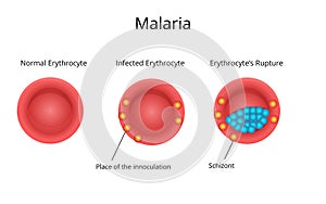 Malaria infection.Normal erythrocyte with the infected blood cell photo