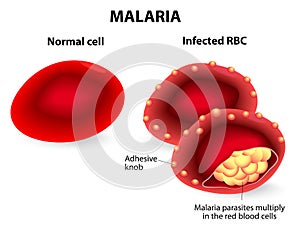 Malaria. Normal and infected red blood cells