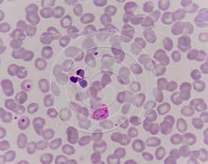 Malaria parasite in blood.