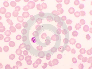 Malaria parasite in red blood cells