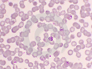 Malaria parasite in red blood cells photo