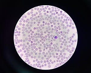 Malaria pigment blood parasite infected red blood cells